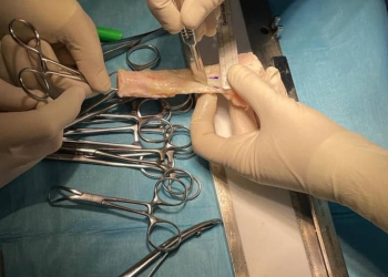 Intervenție de transplant la Spitalul Militar din Timişoara