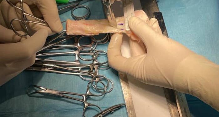 Intervenție de transplant la Spitalul Militar din Timişoara