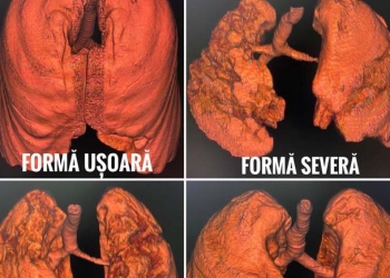 Nu vă jucați cu sănătatea! Vezi cum arată plămânii după infectarea cu COVID-19