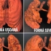 Nu vă jucați cu sănătatea! Vezi cum arată plămânii după infectarea cu COVID-19