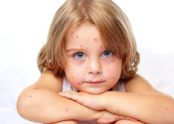Bolile copilăriei revin după relaxările măsurilor de protecție anticovid! „Explozie” de cazuri de varicelă în Timiș