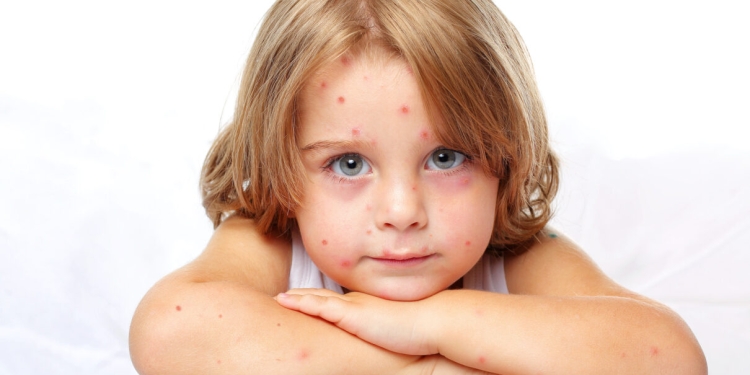 Bolile copilăriei revin după relaxările măsurilor de protecție anticovid! „Explozie” de cazuri de varicelă în Timiș