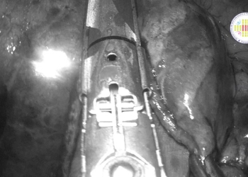 VIDEO Procedură nouă la Spitalul „Victor Babeș” din Timișoara. Medicii folosesc chirurgia toracoscopică video-asistată pentru rezecția unor tumori