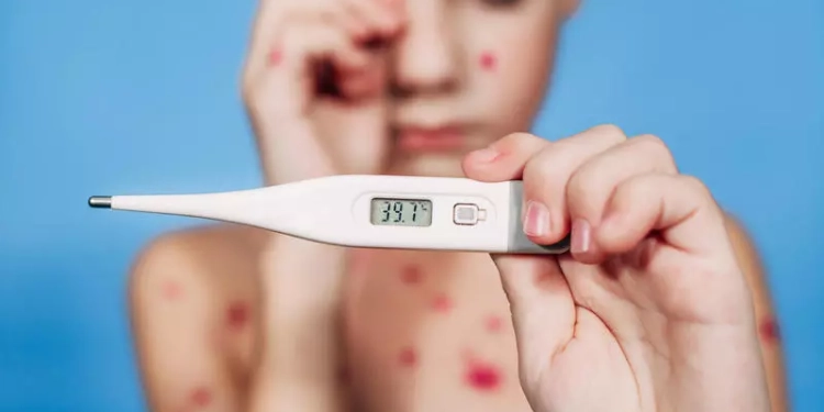 Carantină obligatorie pentru persoanele infectate cu variola maimuței. Află care este țara care a introdus