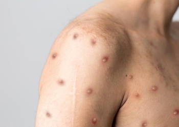 Încă 3 cazuri de variola maimuței în România