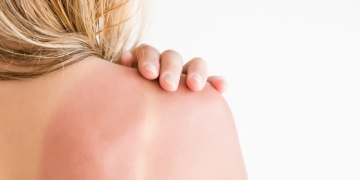 Dermatologii timișoreni, sfaturi pentru protecția pielii în zilele caniculare