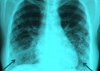 A fost lansată prima platfomă dedicată pacienților cu  afecțiuni pulmonare