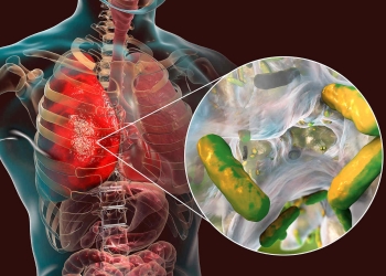 Pneumolog timișorean, despre fibroza chistică: Duce la apariția diabetului zaharat sau a cirozei hepatice
