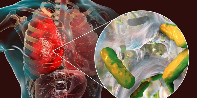 Pneumolog timișorean, despre fibroza chistică: Duce la apariția diabetului zaharat sau a cirozei hepatice