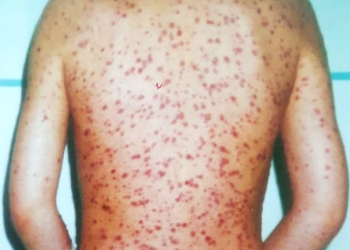 Copil cu o boală rară, internat la Spitalul Victor Babeș din Timișoara. Medicii luptă pentru vindecarea lui