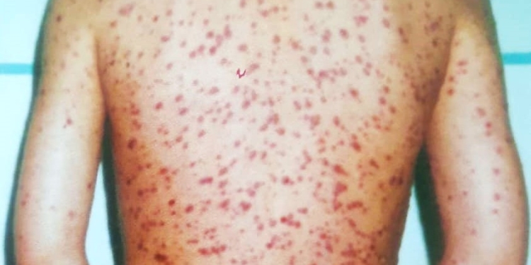 Copil cu o boală rară, internat la Spitalul Victor Babeș din Timișoara. Medicii luptă pentru vindecarea lui