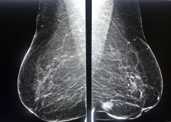 Spitalul de Boli Infecțioase din Timișoara, sfaturi utile despre mamografie