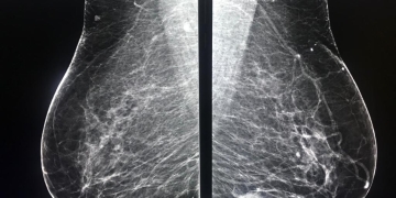 Spitalul de Boli Infecțioase din Timișoara, sfaturi utile despre mamografie