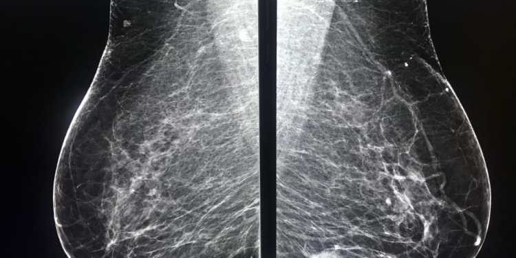 Spitalul de Boli Infecțioase din Timișoara, sfaturi utile despre mamografie