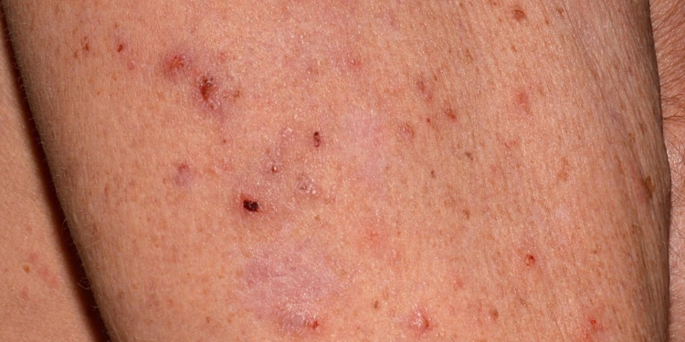 Medic timișorean: Scabia, afecțiunea dermatologică ce necesită tratament urgent