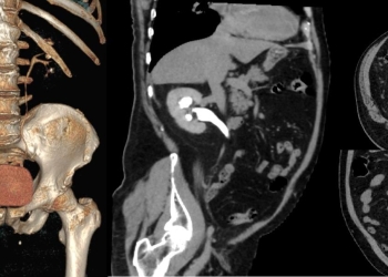 Tractul urinar, evaluat prin tomografie computerizată gratuită la Spitalul Victor Babeș din Timișoara