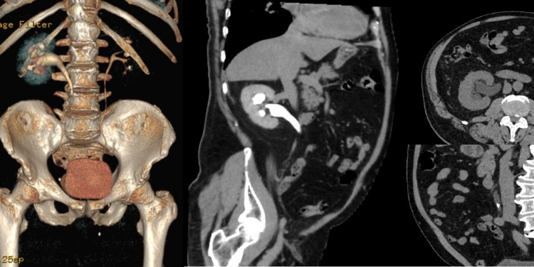 Tractul urinar, evaluat prin tomografie computerizată gratuită la Spitalul Victor Babeș din Timișoara