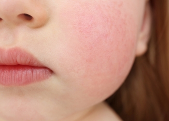 „Boala Obrajilor Pălmuiți”, o afecțiune tot mai frecventă la Timișoara