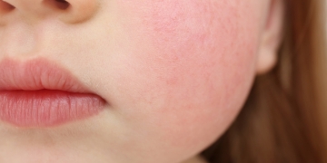 „Boala Obrajilor Pălmuiți”, o afecțiune tot mai frecventă la Timișoara