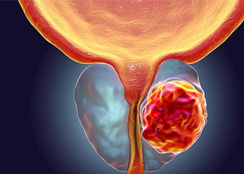 RMN-ul de prostată, realizat gratuit la Spitalul Victor Babeș din Timișoara