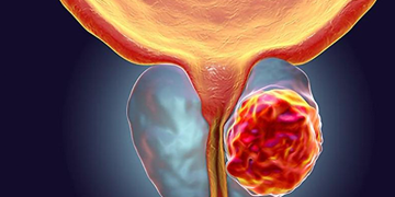 RMN-ul de prostată, realizat gratuit la Spitalul Victor Babeș din Timișoara