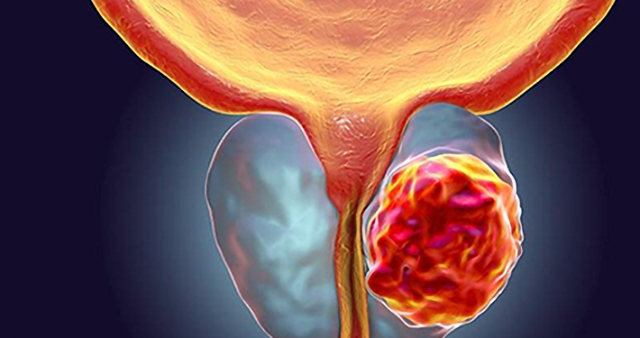 RMN-ul de prostată, realizat gratuit la Spitalul Victor Babeș din Timișoara