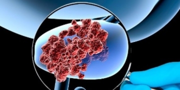 Spitalul „Victor Babeș” din Timișoara: 1 din 8 bărbați ajunge să aibă cancer de prostată