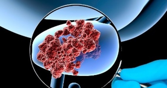 Spitalul „Victor Babeș” din Timișoara: 1 din 8 bărbați ajunge să aibă cancer de prostată