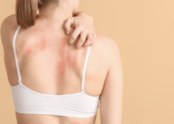 O afecțiune dermatologică caracterizată prin apariția unor noduli duri, tratată la Spitalul CFR din Timișoara