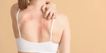 O afecțiune dermatologică caracterizată prin apariția unor noduli duri, tratată la Spitalul CFR din Timișoara