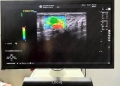 Ecograf de ultimă generație la OncoHelp, care ajută la creşterea acurateţii diagnosticului