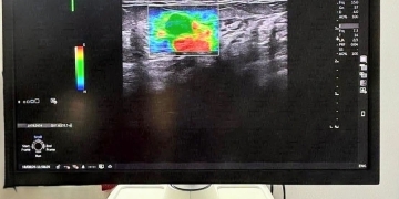 Ecograf de ultimă generație la OncoHelp, care ajută la creşterea acurateţii diagnosticului